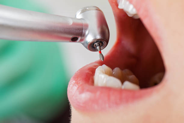 Best Emergency Root Canal Treatment in Rockville, IN